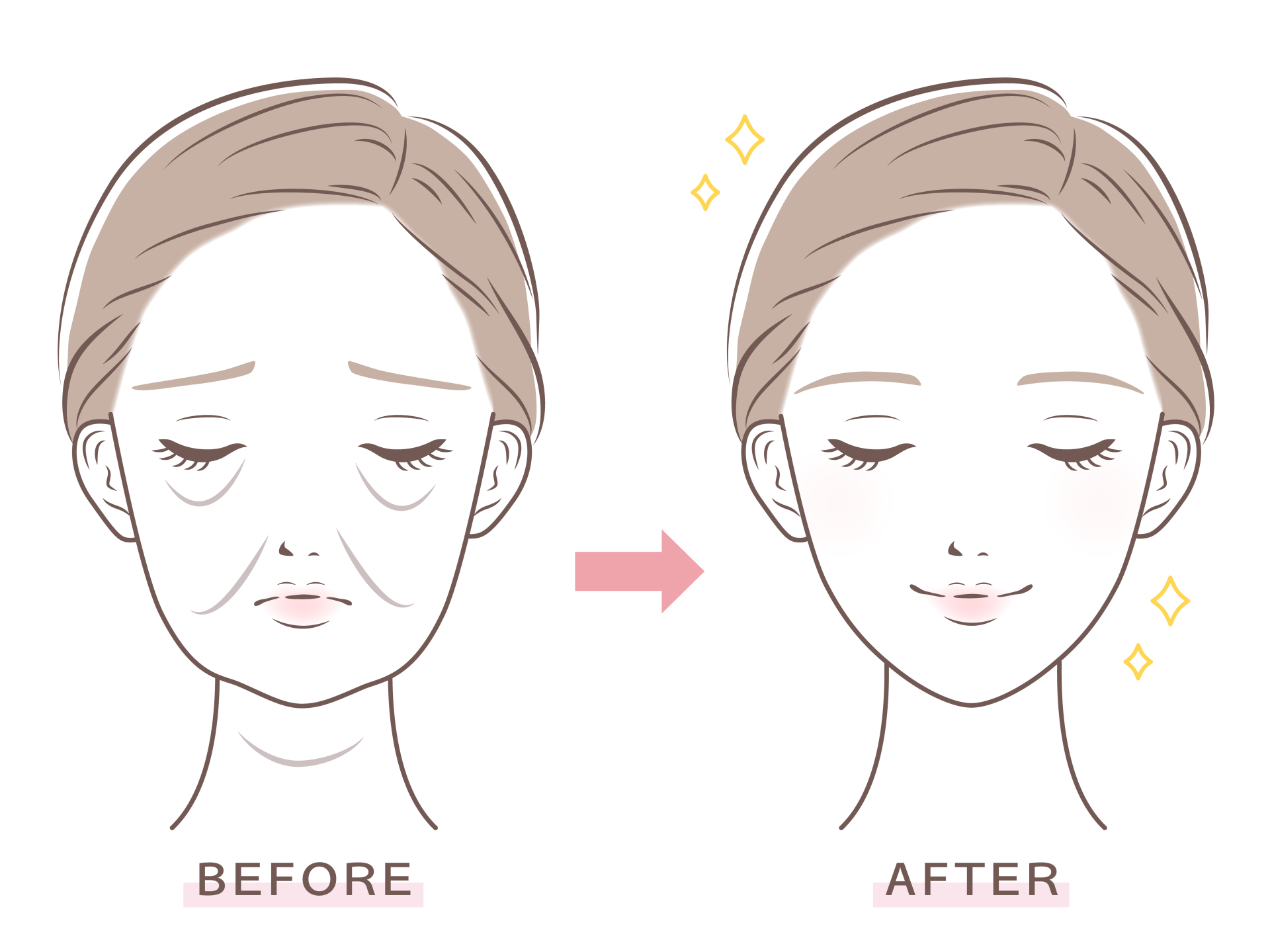 【美容鍼】そのたるみ、年齢のせいじゃない？自然にリフトアップする美容鍼とは